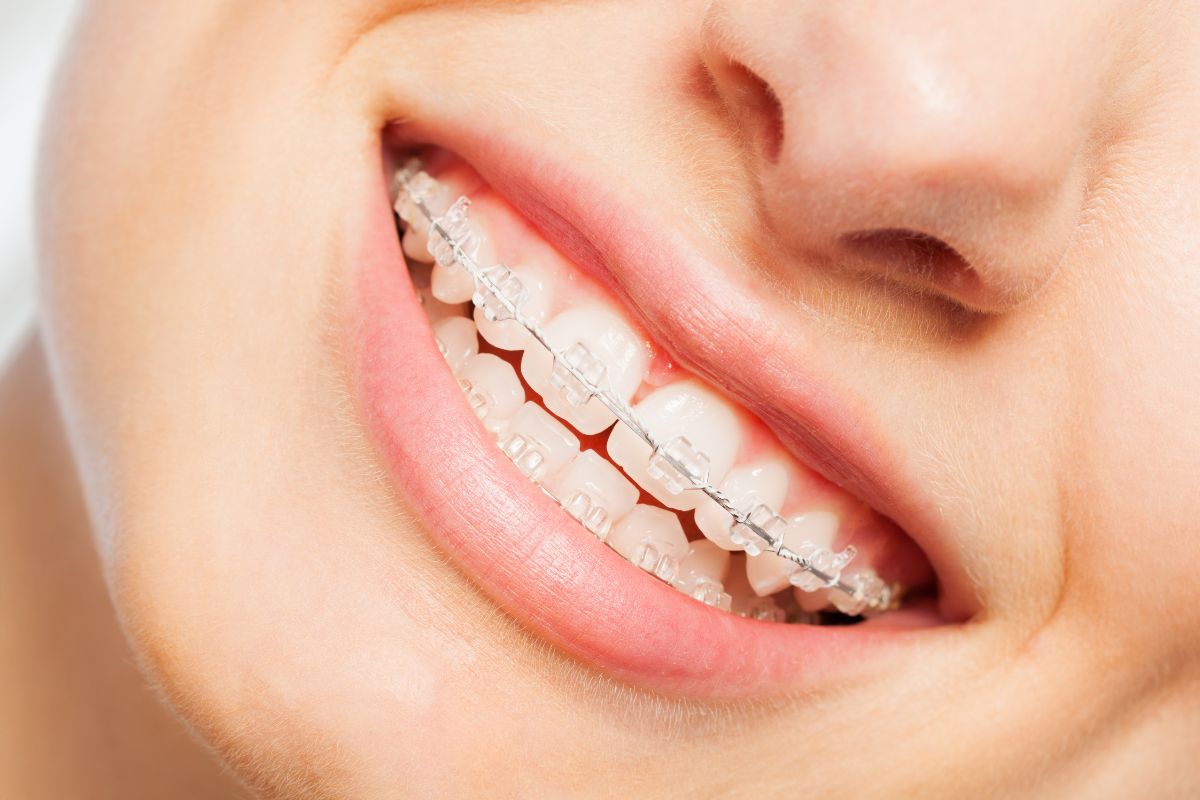Clarity SL braces