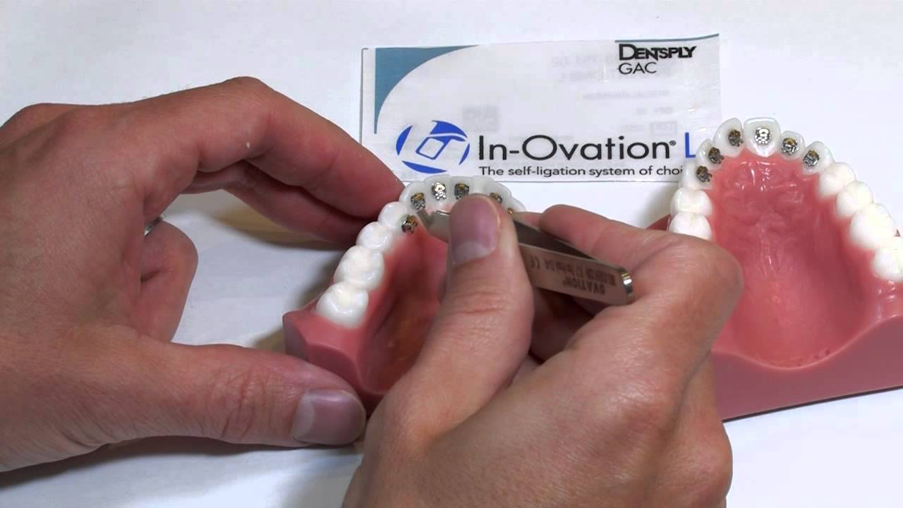 In-Ovation braces